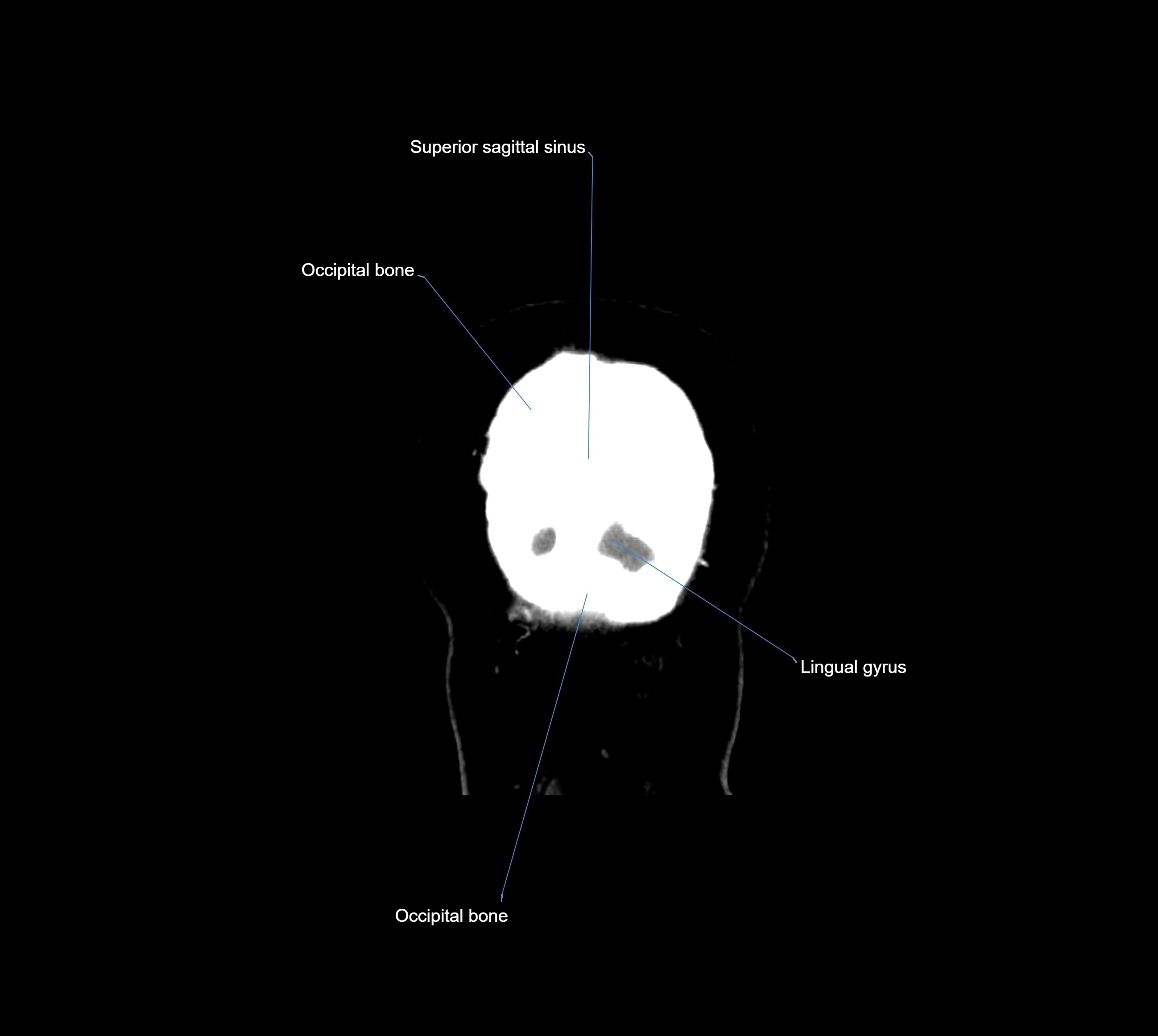 CT Brain coronal cross sectional radiology anatomy image  -img-00001-044.webp
